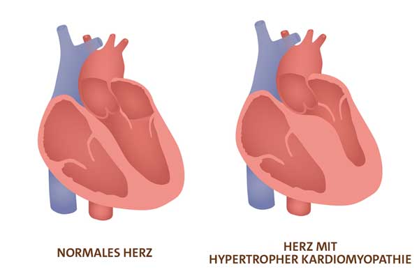 Grafik: ein Herz mit hypertropher Kardiomyopathie (HCM)